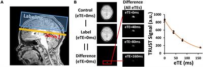 Brain Oxygen Extraction and Metabolism in Pediatric Patients With Sickle Cell Disease: Comparison of Four Calibration Models